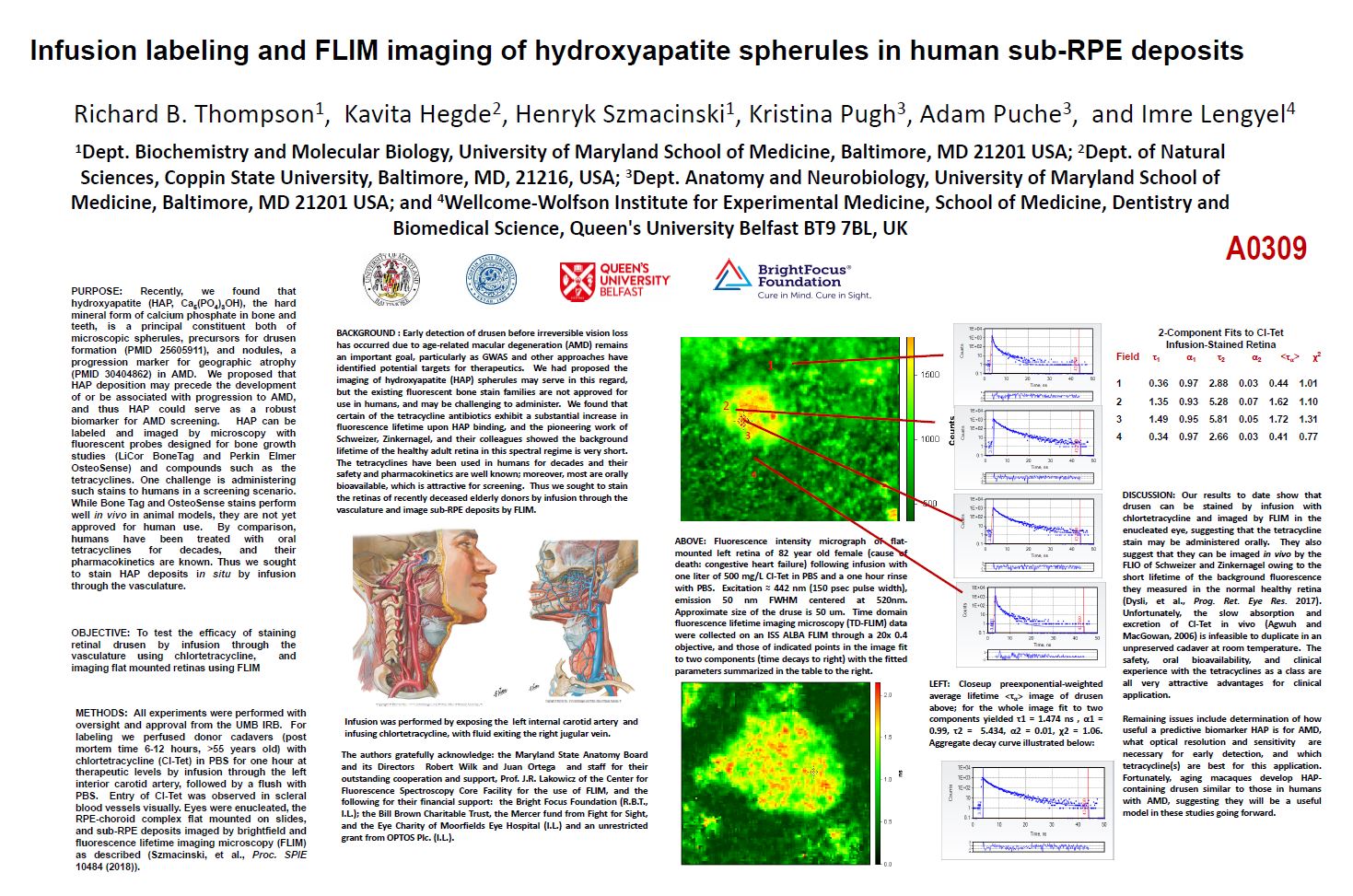 infusion_labeling_and_flim_imaging_of_hydroxyapaptite_spherules_in_human_sub-rpe_deposits